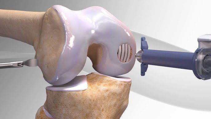 Cartilage Repair
