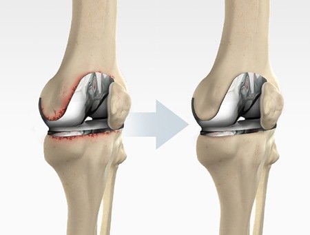 Revision Arthroplasty